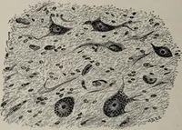 An illustration from A text-book of pathology / by Alfred Stengel ; with 394 illustrations in the text, many of them in colors, and 7 full-page chromolithographic plates. (1903)