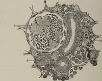 An illustration from A text-book of pathology / by Alfred Stengel ; with 394 illustrations in the text, many of them in colors, and 7 full-page chromolithographic plates. (1903)
