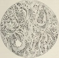 Picture 9 of 178 from A text-book of pathology / by Alfred Stengel ; with 394 illustrations in the text, many of them in colors, and 7 full-page chromolithographic plates. (1903), leaf 85