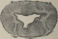 An illustration from A text-book of pathology / by Alfred Stengel ; with 394 illustrations in the text, many of them in colors, and 7 full-page chromolithographic plates. (1903)