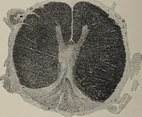 An illustration from A text-book of pathology / by Alfred Stengel ; with 394 illustrations in the text, many of them in colors, and 7 full-page chromolithographic plates. (1903)