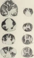 An illustration from A text-book of pathology / by Alfred Stengel ; with 394 illustrations in the text, many of them in colors, and 7 full-page chromolithographic plates. (1903)