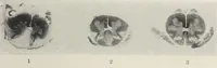 Picture 170 of 178 from A text-book of pathology / by Alfred Stengel ; with 394 illustrations in the text, many of them in colors, and 7 full-page chromolithographic plates. (1903), leaf 883