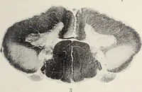 An illustration from A text-book of pathology / by Alfred Stengel ; with 394 illustrations in the text, many of them in colors, and 7 full-page chromolithographic plates. (1903)