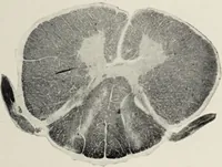 Picture 173 of 178 from A text-book of pathology / by Alfred Stengel ; with 394 illustrations in the text, many of them in colors, and 7 full-page chromolithographic plates. (1903), leaf 885