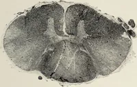 An illustration from A text-book of pathology / by Alfred Stengel ; with 394 illustrations in the text, many of them in colors, and 7 full-page chromolithographic plates. (1903)