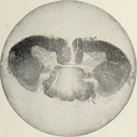 An illustration from A text-book of pathology / by Alfred Stengel ; with 394 illustrations in the text, many of them in colors, and 7 full-page chromolithographic plates. (1903)