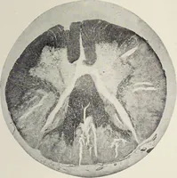 An illustration from A text-book of pathology / by Alfred Stengel ; with 394 illustrations in the text, many of them in colors, and 7 full-page chromolithographic plates. (1903)