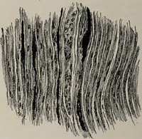 An illustration from A text-book of pathology / by Alfred Stengel ; with 394 illustrations in the text, many of them in colors, and 7 full-page chromolithographic plates. (1903)