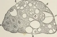 An illustration from A text-book of pathology / by Alfred Stengel ; with 394 illustrations in the text, many of them in colors, and 7 full-page chromolithographic plates. (1903)