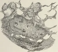 An illustration from A text-book of pathology / by Alfred Stengel ; with 394 illustrations in the text, many of them in colors, and 7 full-page chromolithographic plates. (1903)