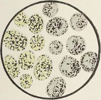 Picture 13 of 178 from A text-book of pathology / by Alfred Stengel ; with 394 illustrations in the text, many of them in colors, and 7 full-page chromolithographic plates. (1903), leaf 95