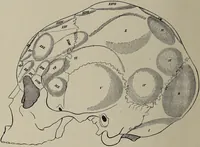 An illustration from Franz Joseph Gall / von P. J. Möbius. (1905)